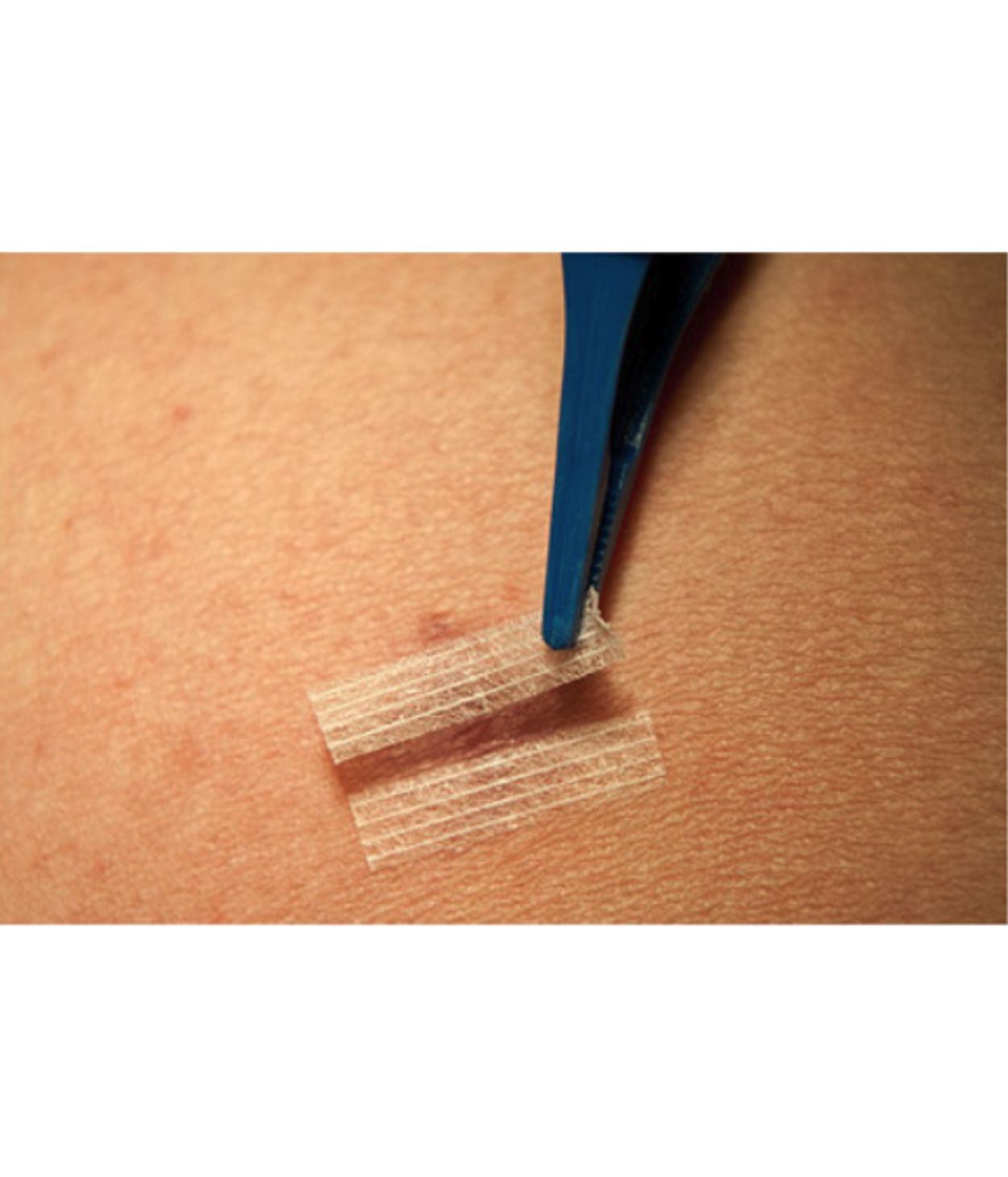 Strimlaplástur Hvítur 3x75mm 1stk (50stk/pk)